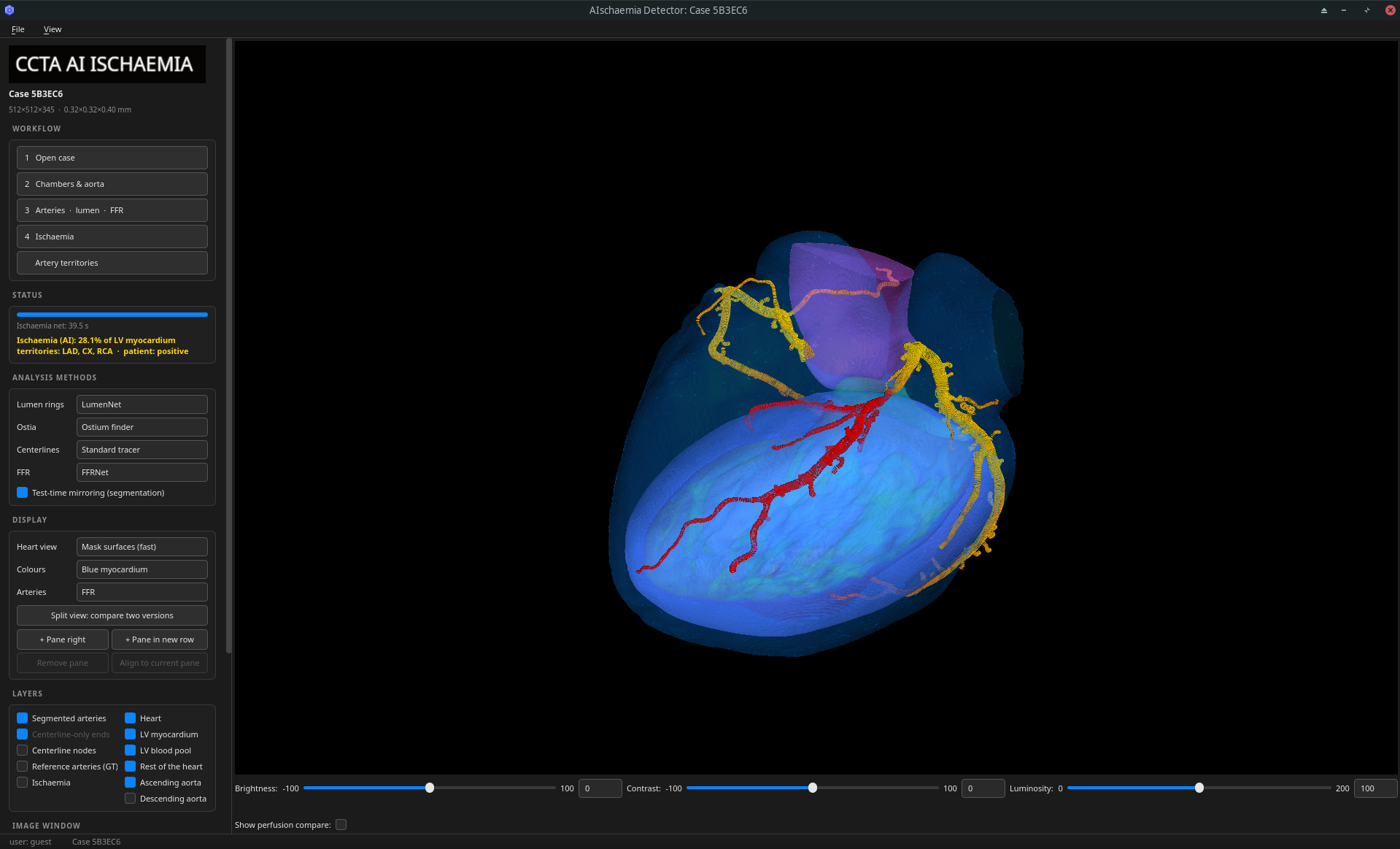 Screenshot of the AI Hexeract desktop application: workflow panel with Open case, Chambers and aorta, Arteries, lumen and FFR, and Ischaemia steps; analysis-method selectors; 3D heart with FFR-coloured coronary tree.