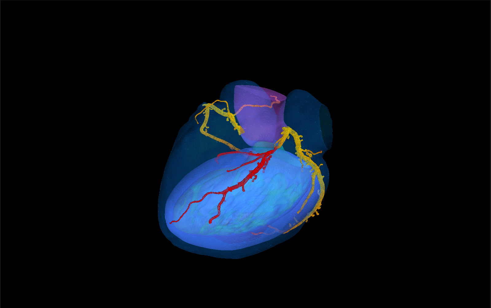3D rendering of a heart from a coronary CT: blue left-ventricular myocardium, coronary arteries coloured by predicted FFR from yellow (normal) to red (reduced) along the left anterior descending artery.